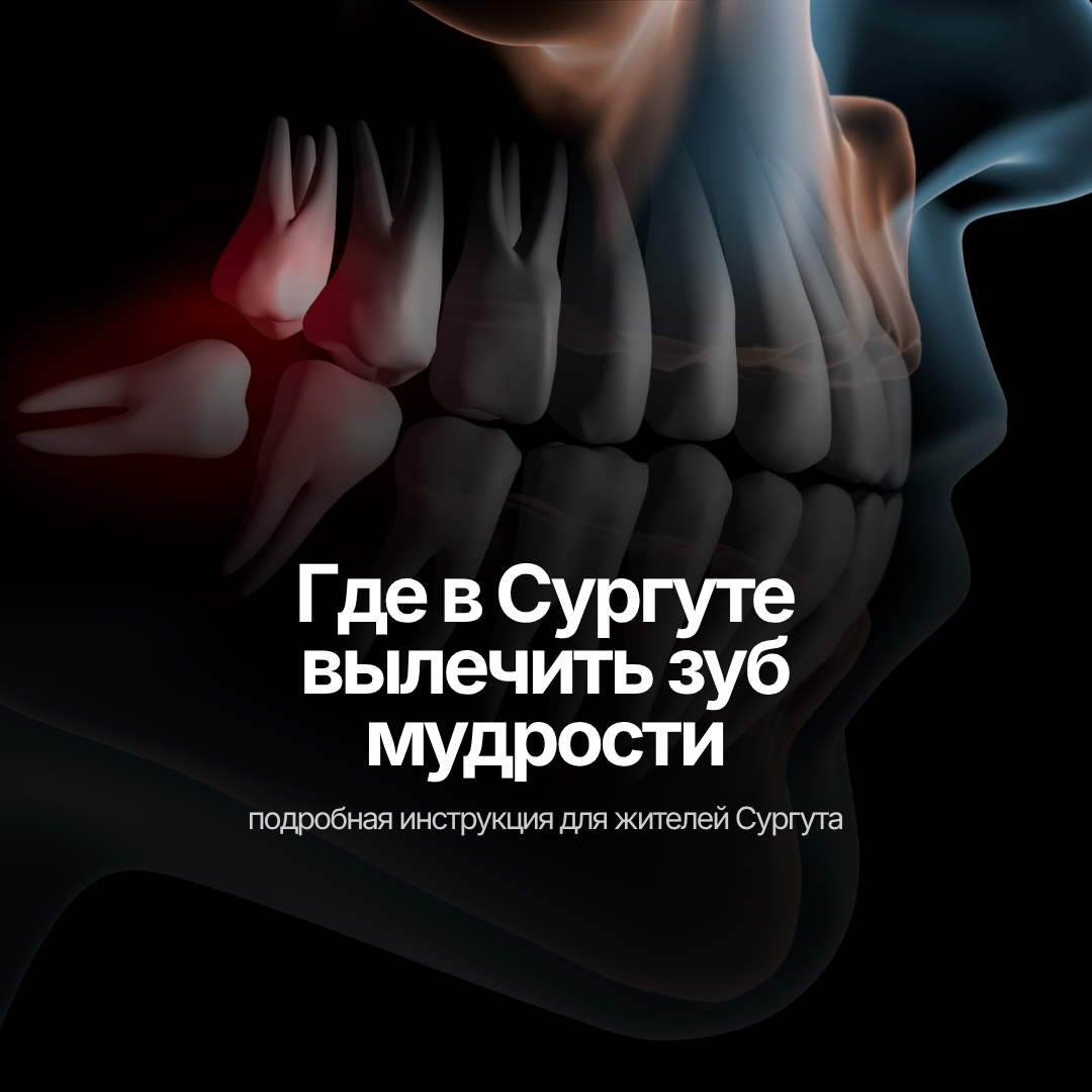 Где в Сургуте вылечить зуб мудрости