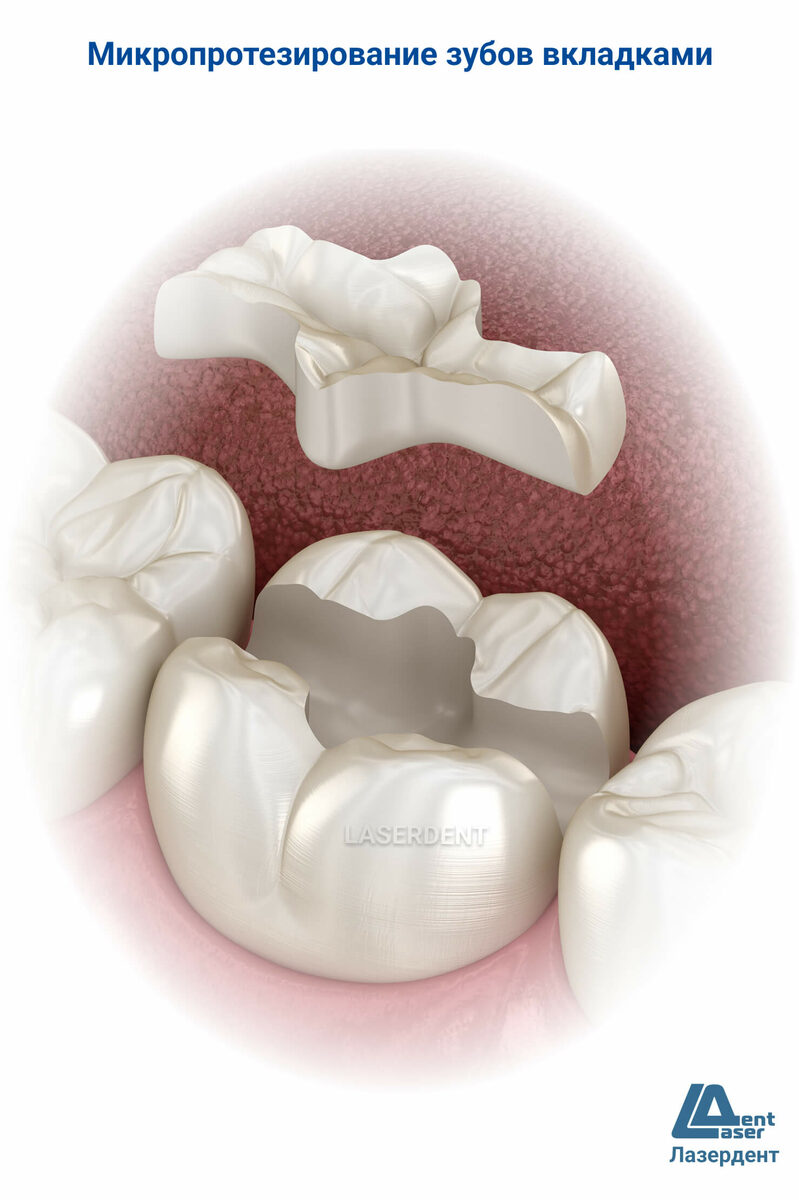 Протезирование Зубными Вкладками Лазердент Хабаровск. Цена, Адрес, Телефон