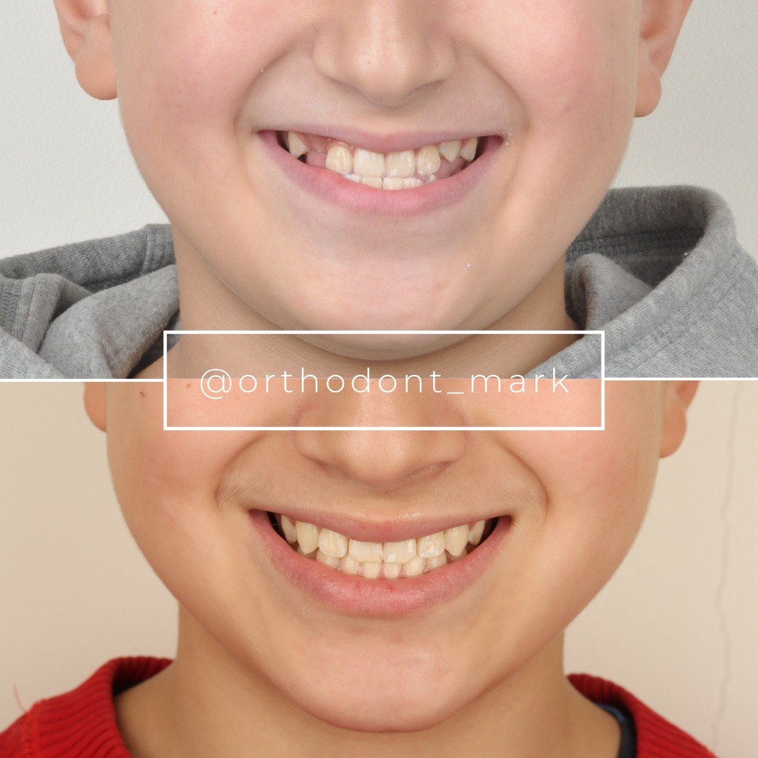 Stage photo documenting MARPE and facial mask treatment progress over time — photo 2 of 7
