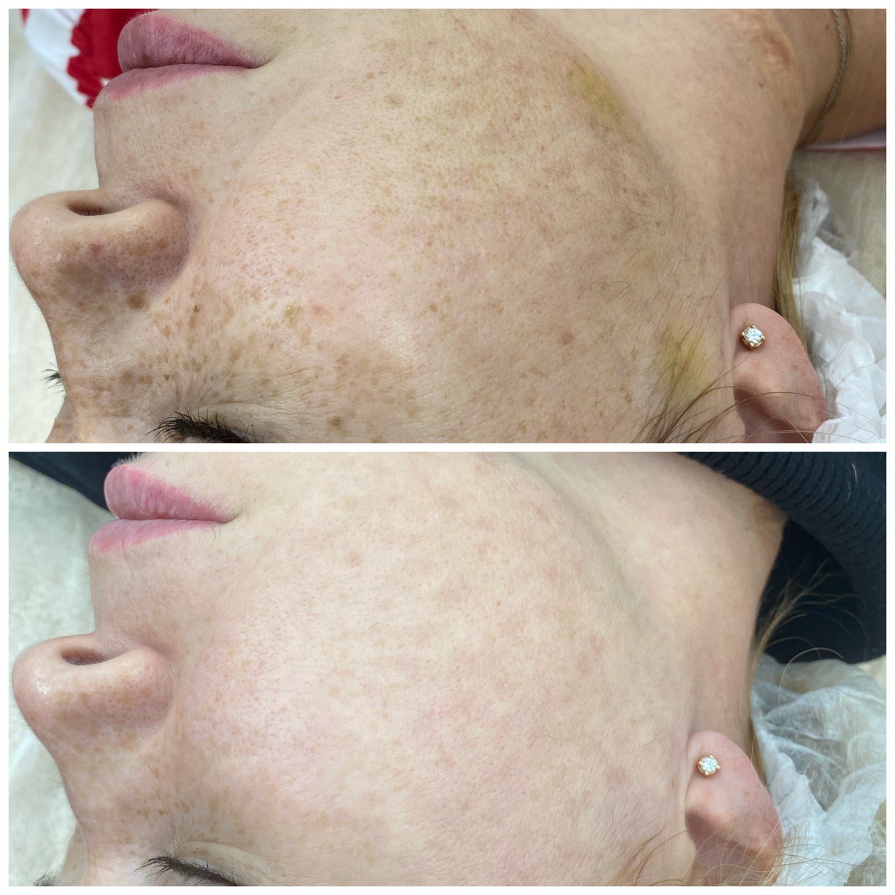 Фото до и после: удаление пигментации лазером в клинике PradusCOSMO, Санкт-Петербург. Безопасная процедура с гарантией результата