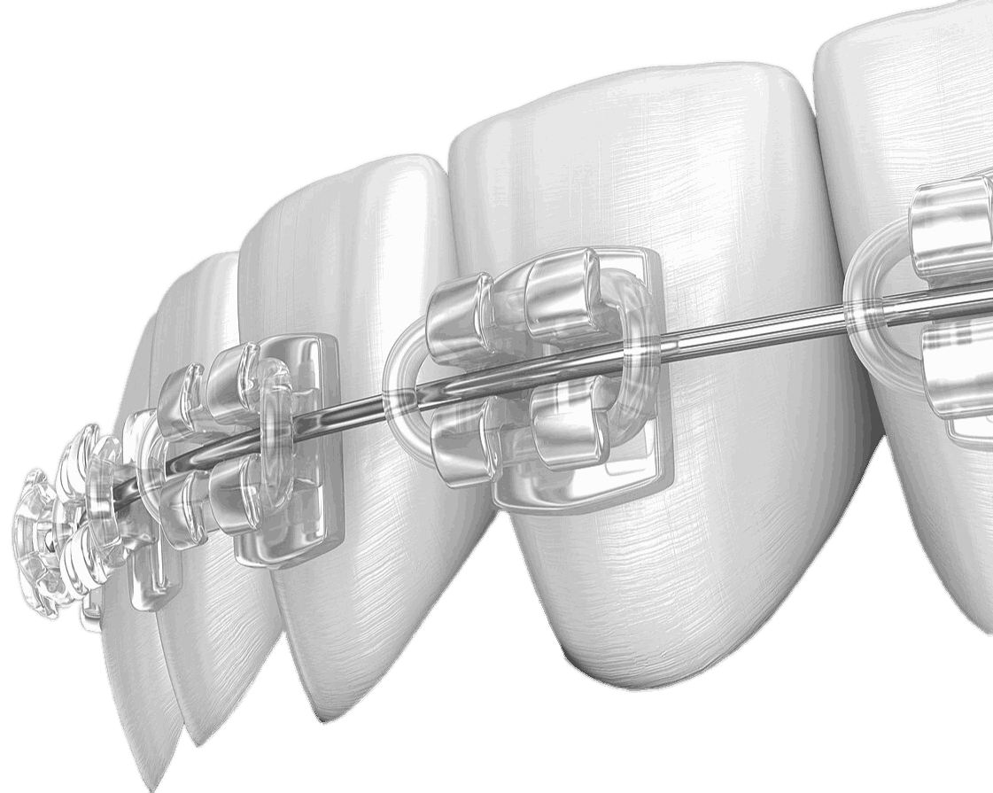Протезы передних зубов в стоматологии Барышева ☎ +7 (908) 237-73-77 