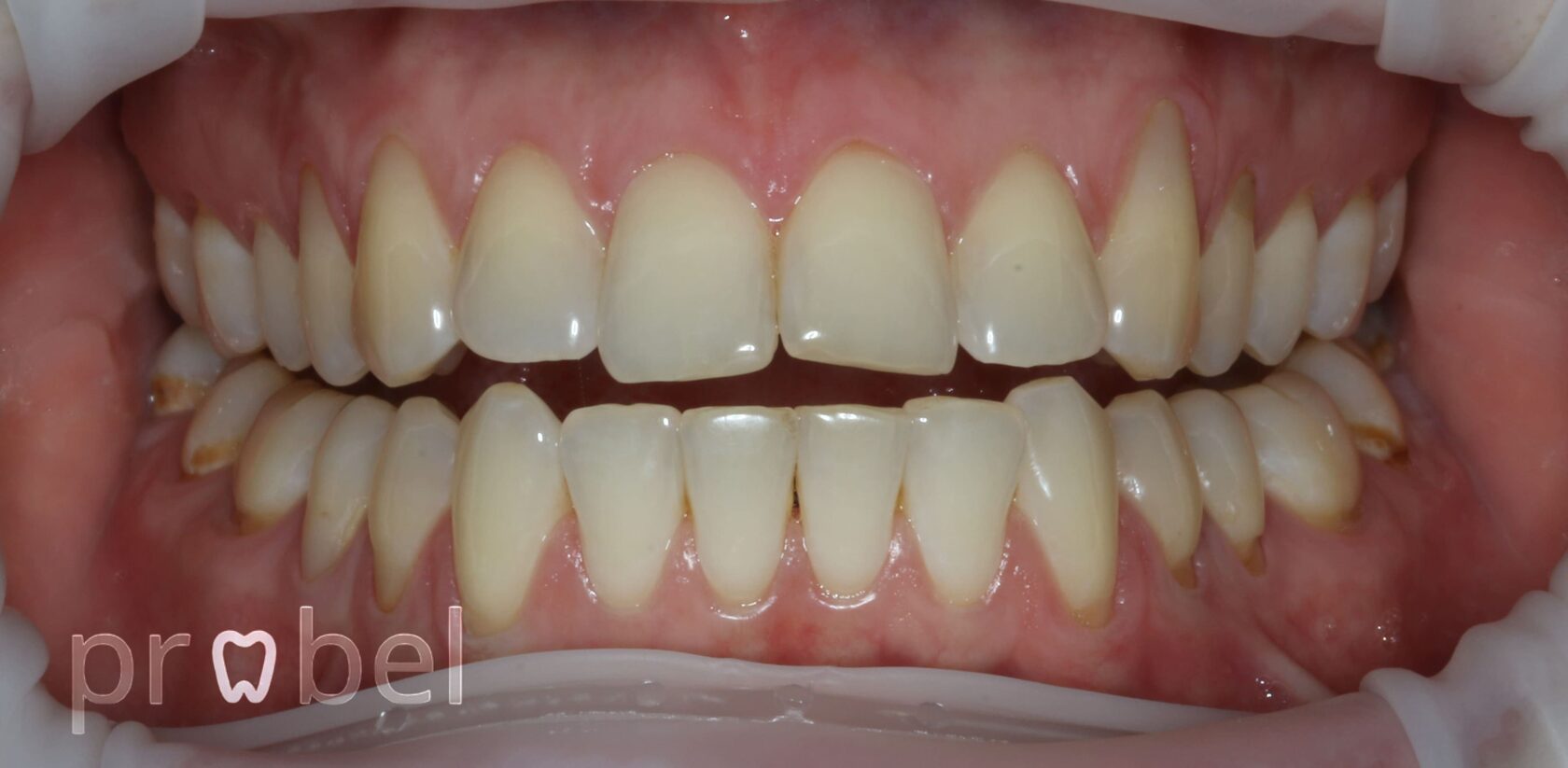 Показания к пластике десны – оголились корни и зубы кажутся длиннее