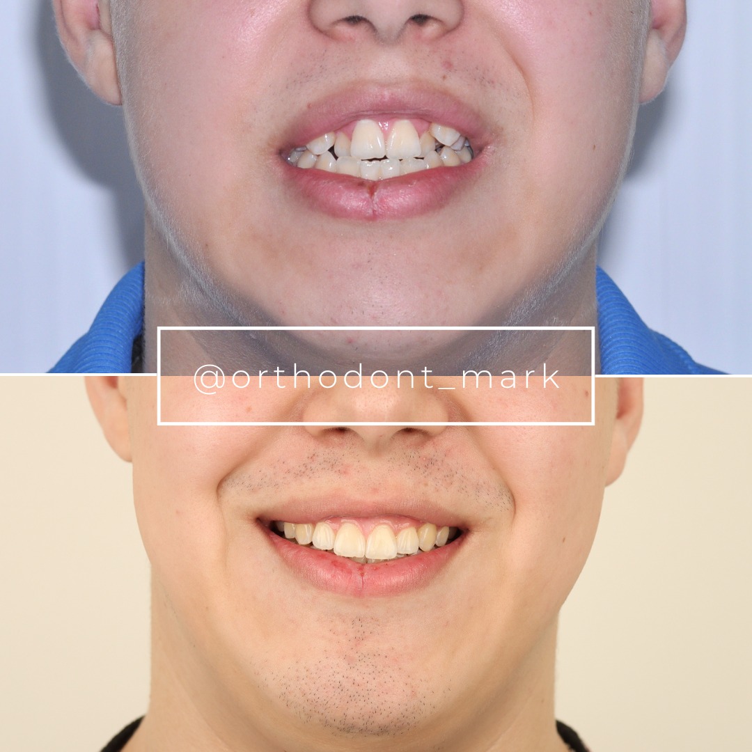 Before and after photo showing improved dental arch harmony and natural smile esthetics