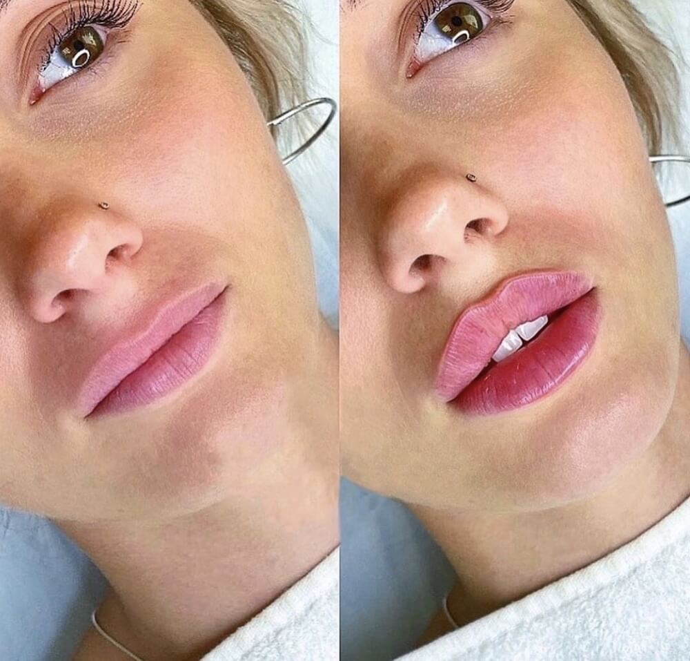 Фото красивых губ после увеличения гиалуроновой кислотой