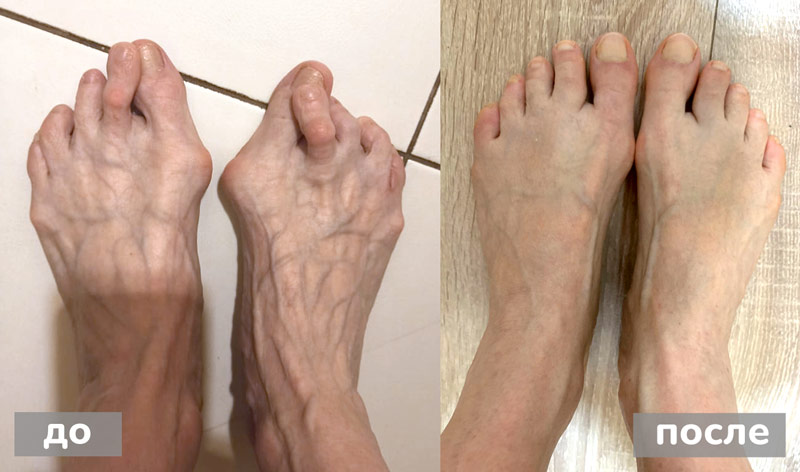 «Косточки на ногах» или «Шишки на ногах» - методы лечения