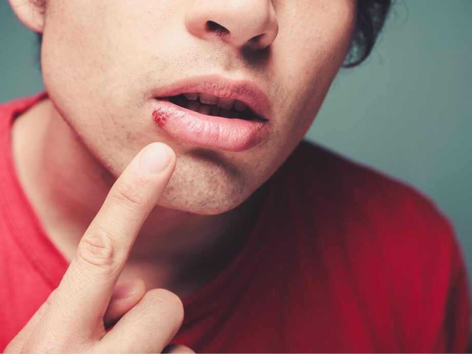 Постоянно появляются заеды в уголках губ? Расскажем почему и как их лечить