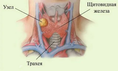 Узлы и кисты щитовидной железы: симптомы, причины и лечение | статьи МЕДСИ-Промедицина