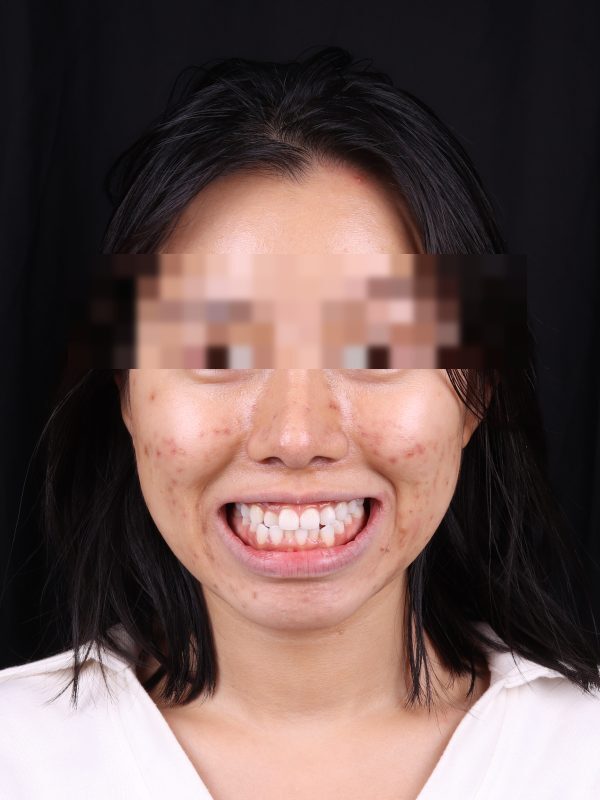 Исправление прикуса — фото до лечения, Elite Denta