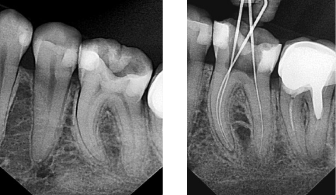 Снимок зубов - лечение пульпита