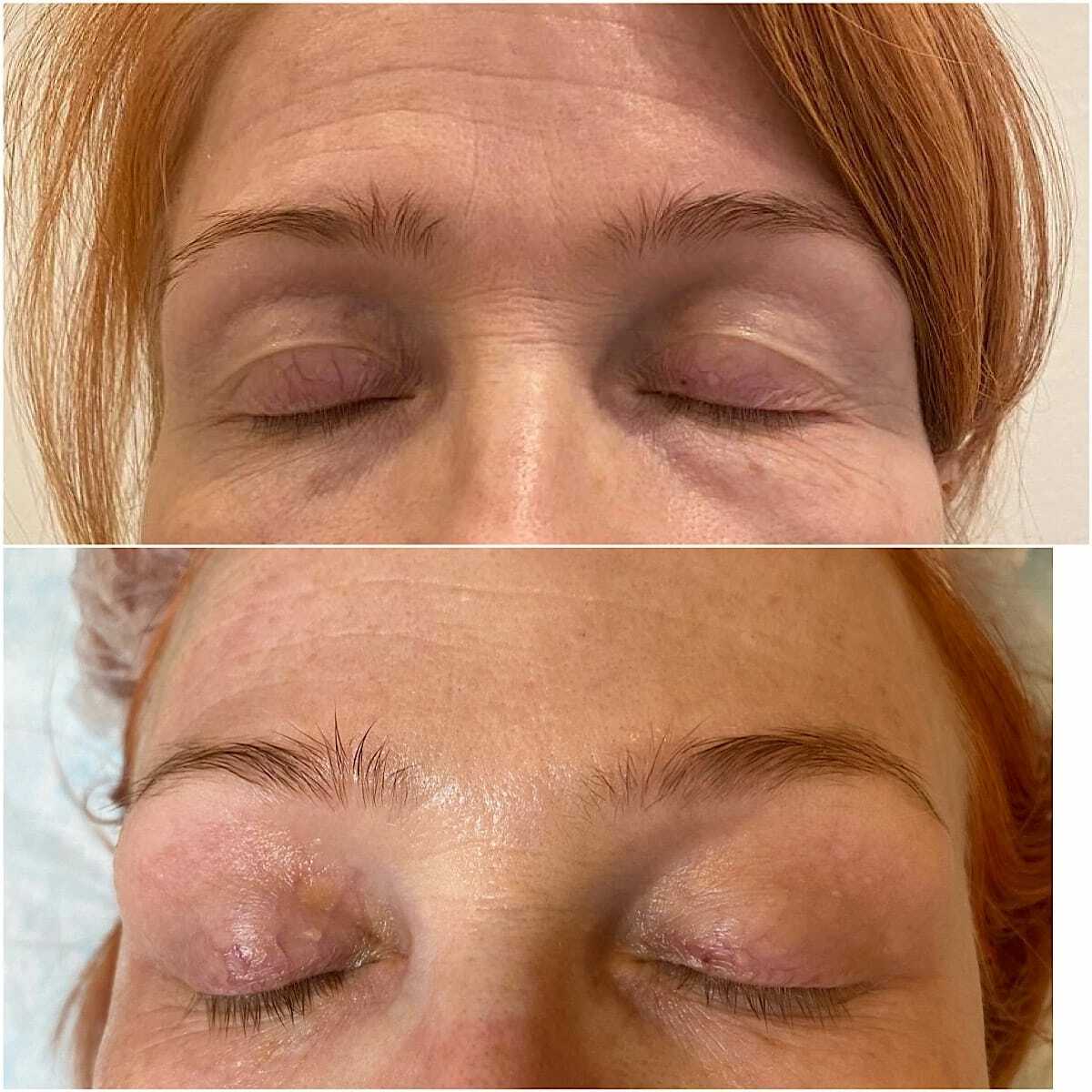 процедура холодная плазма в косметологии для лица