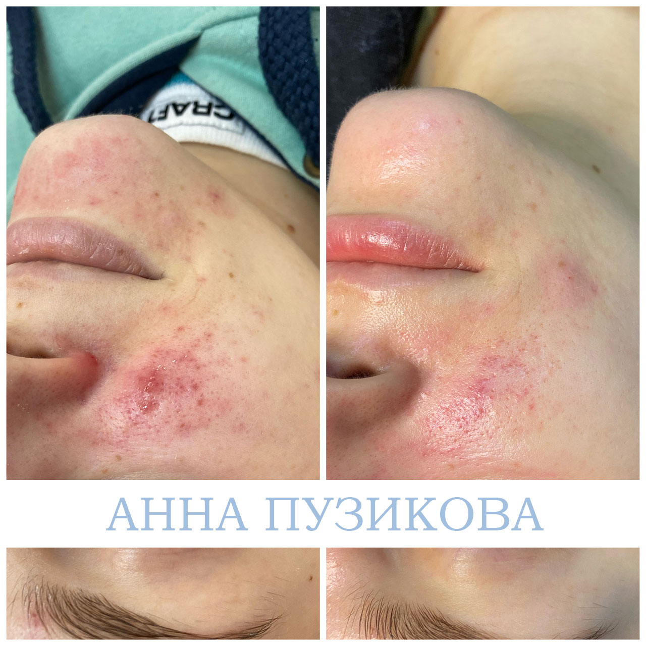 Результат лечения акне и воспалений кожи после курса процедур у косметолога Анны Пузиковой в клинике Прадус (СПб).