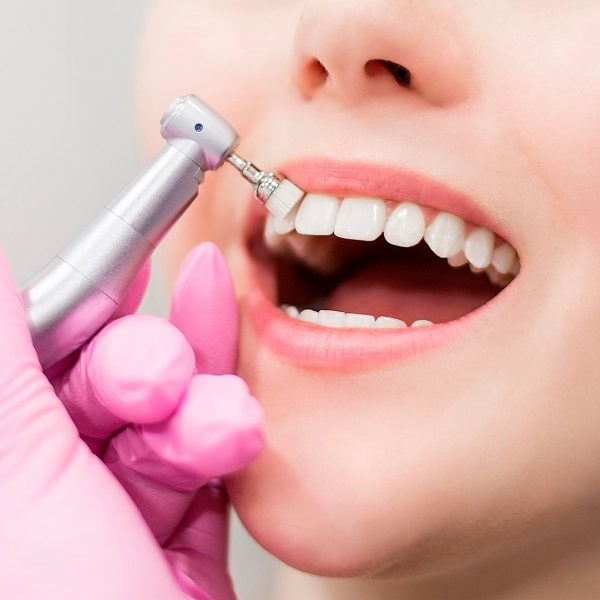 полировка зубов в Ульяновске