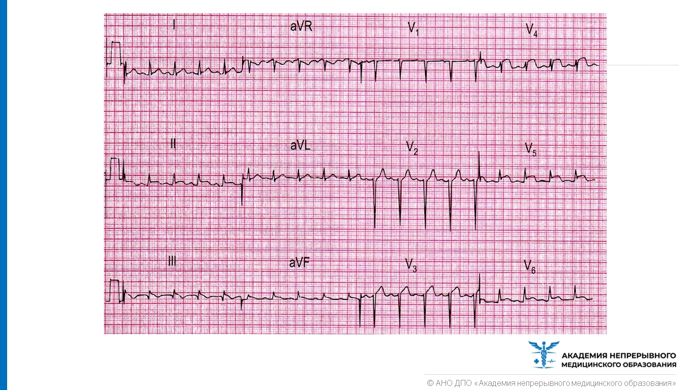 Перикардит экг картина