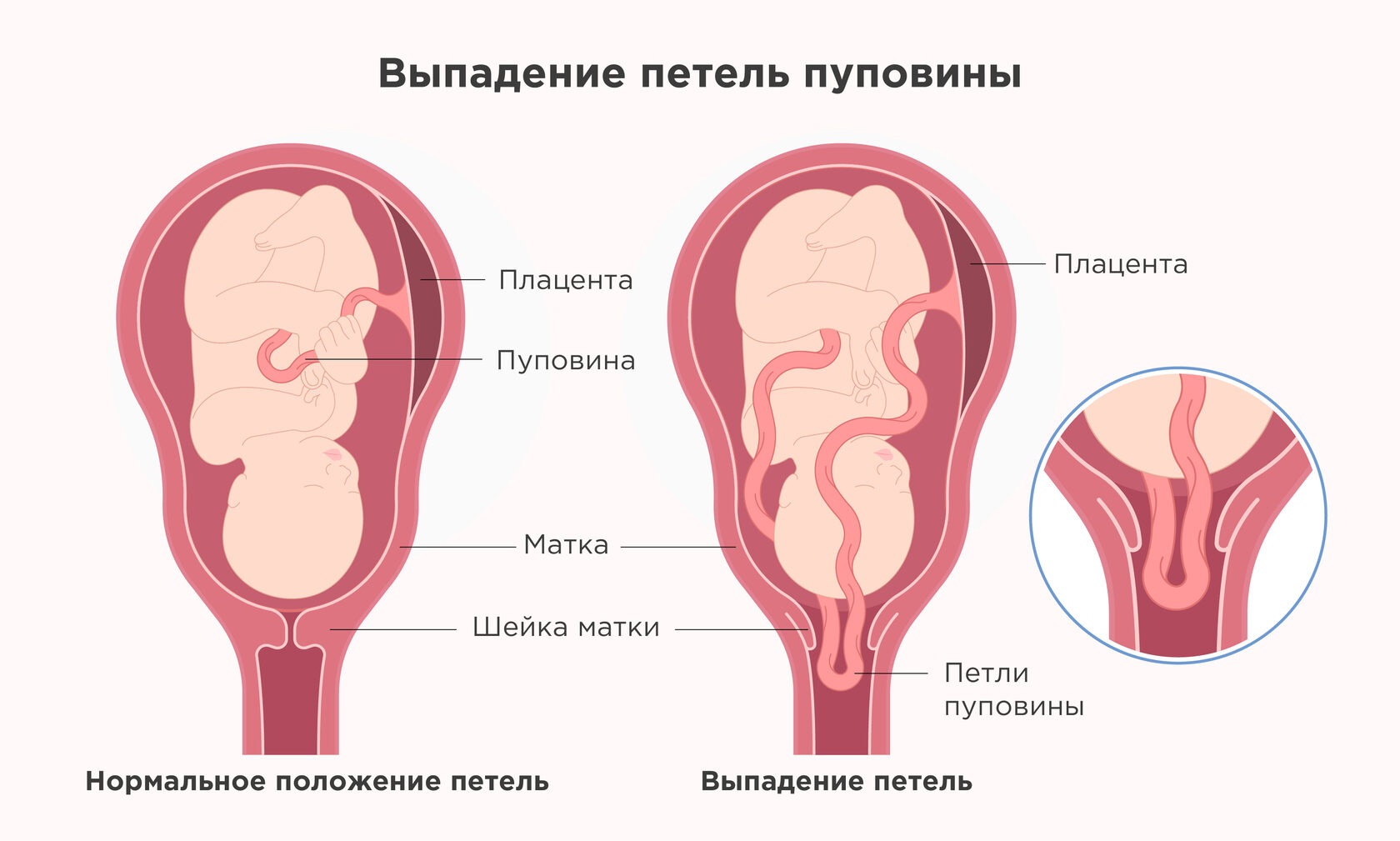 оргазм при беременности и короткая шейка матки при беременности фото 65