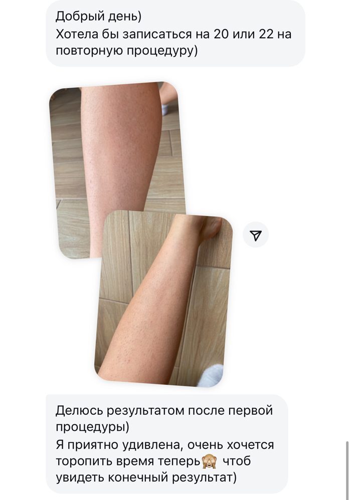Сообщение клиентки о результате лазерной эпиляции ног после первой процедуры