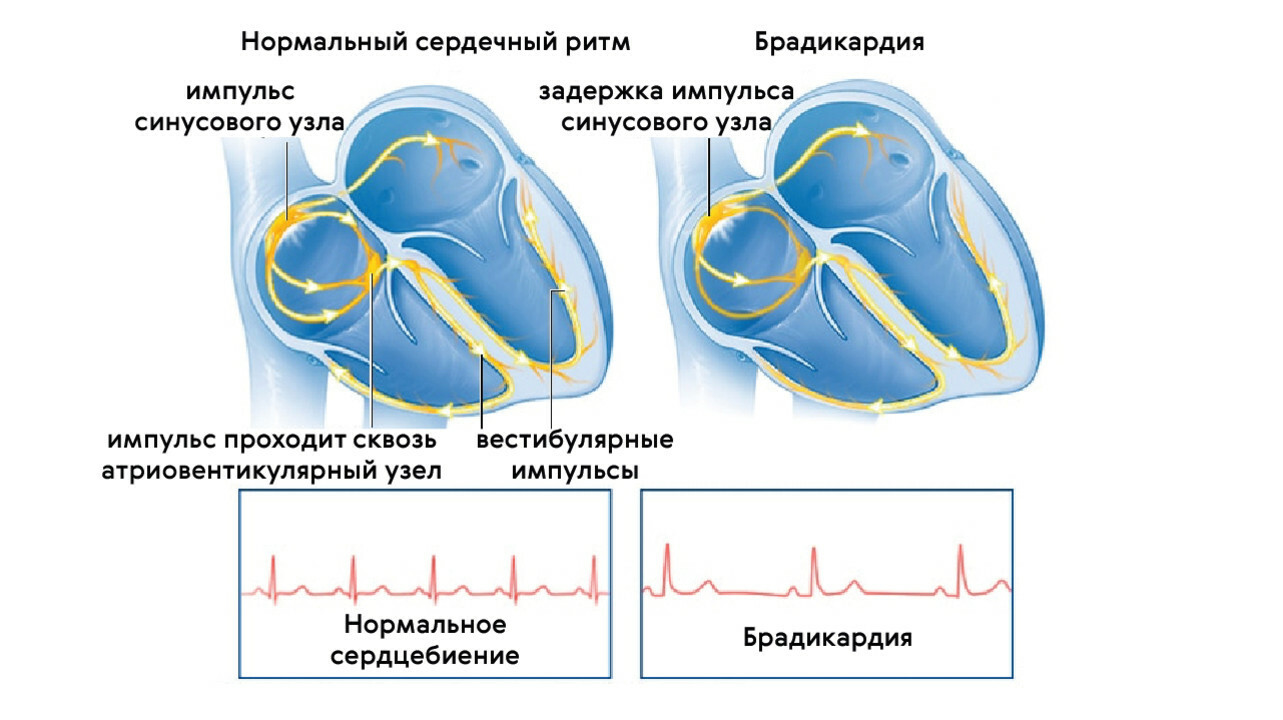 Как нормализовать сердце. Замедление сердечного ритма. Нормальный сердечный ритм. Брадикардия рисунок. Брадикардия классификация.