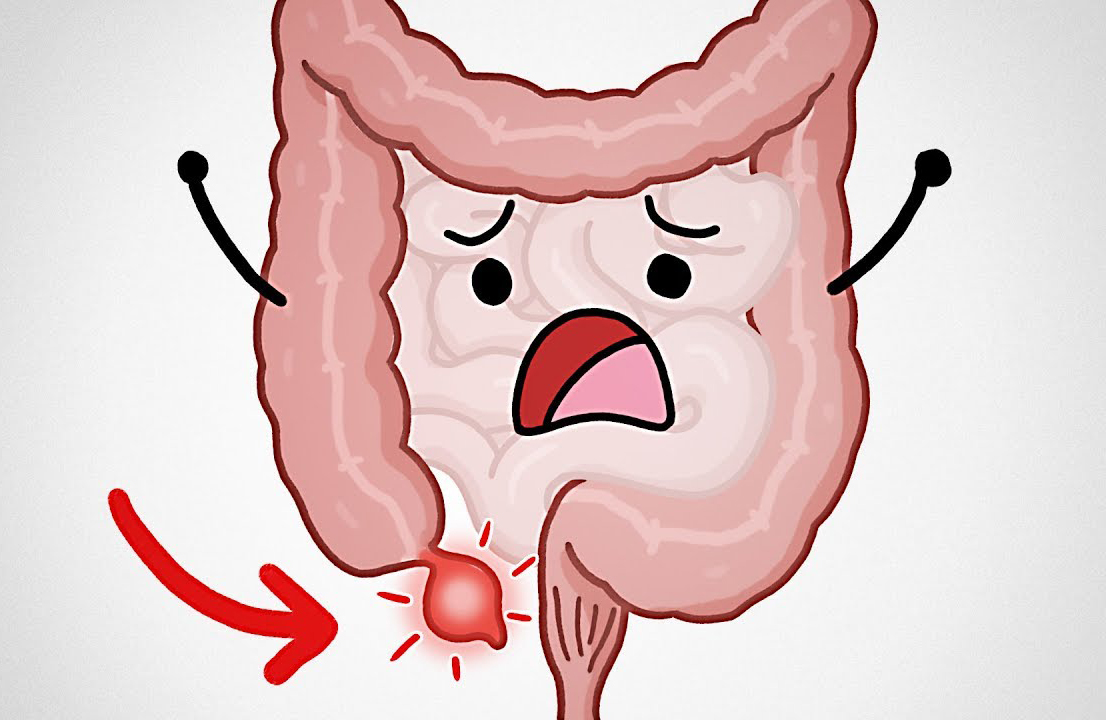 Смешные картинки про аппендицит