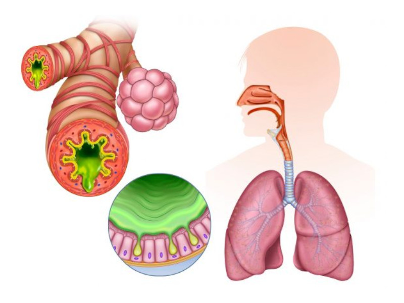 Приступы бронхиальной астмы: почему надо вызывать скорую помощь