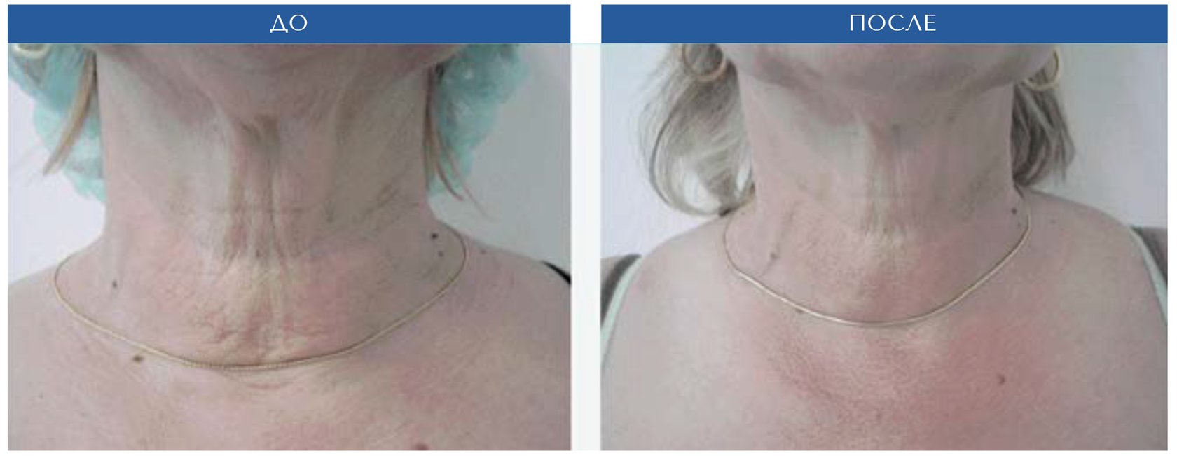 Очищение лица полинуклеотидами до и после фото