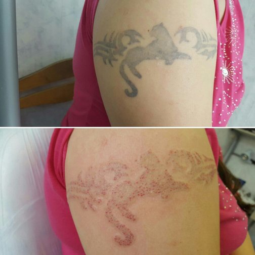 Способы удаления татуировок: 6 проверенных методов