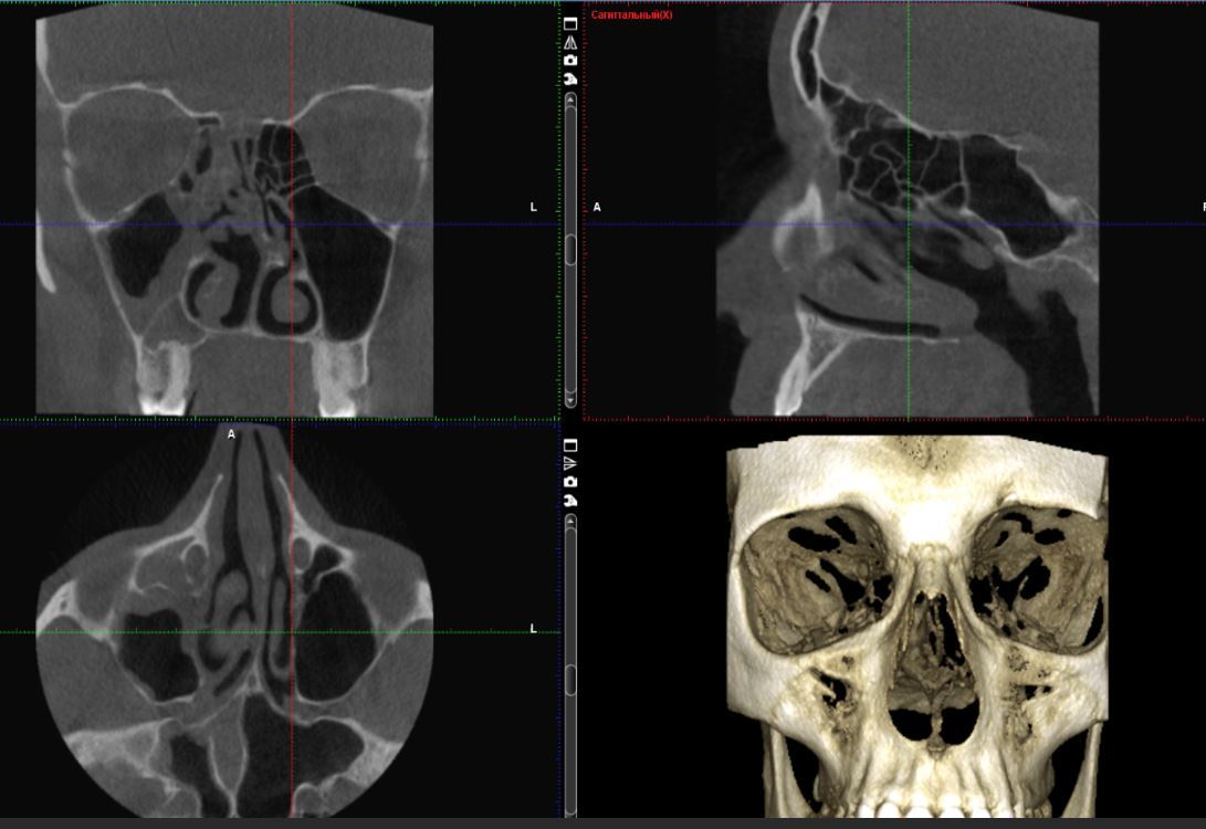 Томография носовых пазух. Остеома верхнечелюстной пазухи кт. Остеома гайморовой пазухи на кт. Конусно-лучевая компьютерная томография пазух носа.