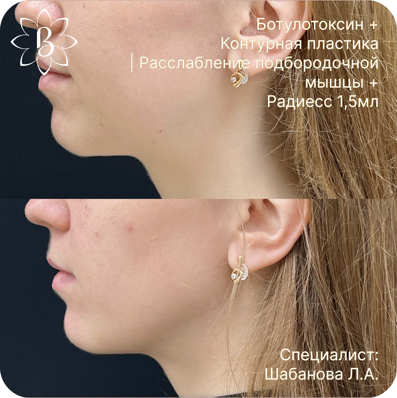 Александритовая лазерная эпиляция СПб