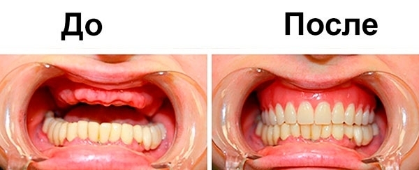 Нейлоновые протезы зубов (мягкие протезы)