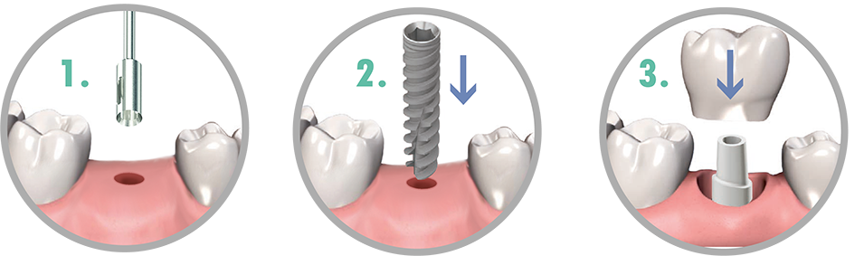 Об имплантации