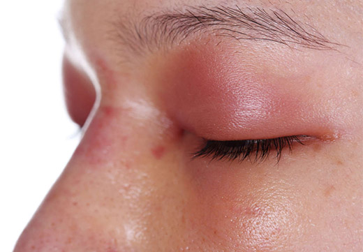 Заболевания кожи вокруг глаз и век
