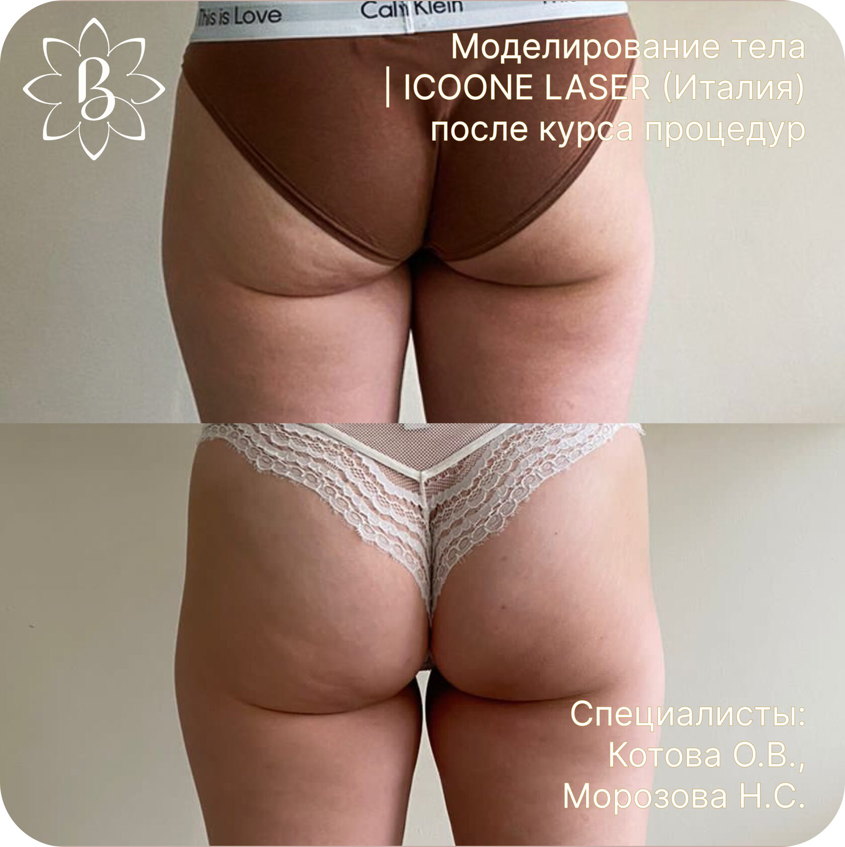 Диодная лазерная эпиляция СПб