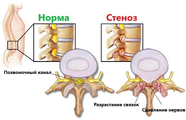 Спондилолистез: лечение, симптомы, причины
