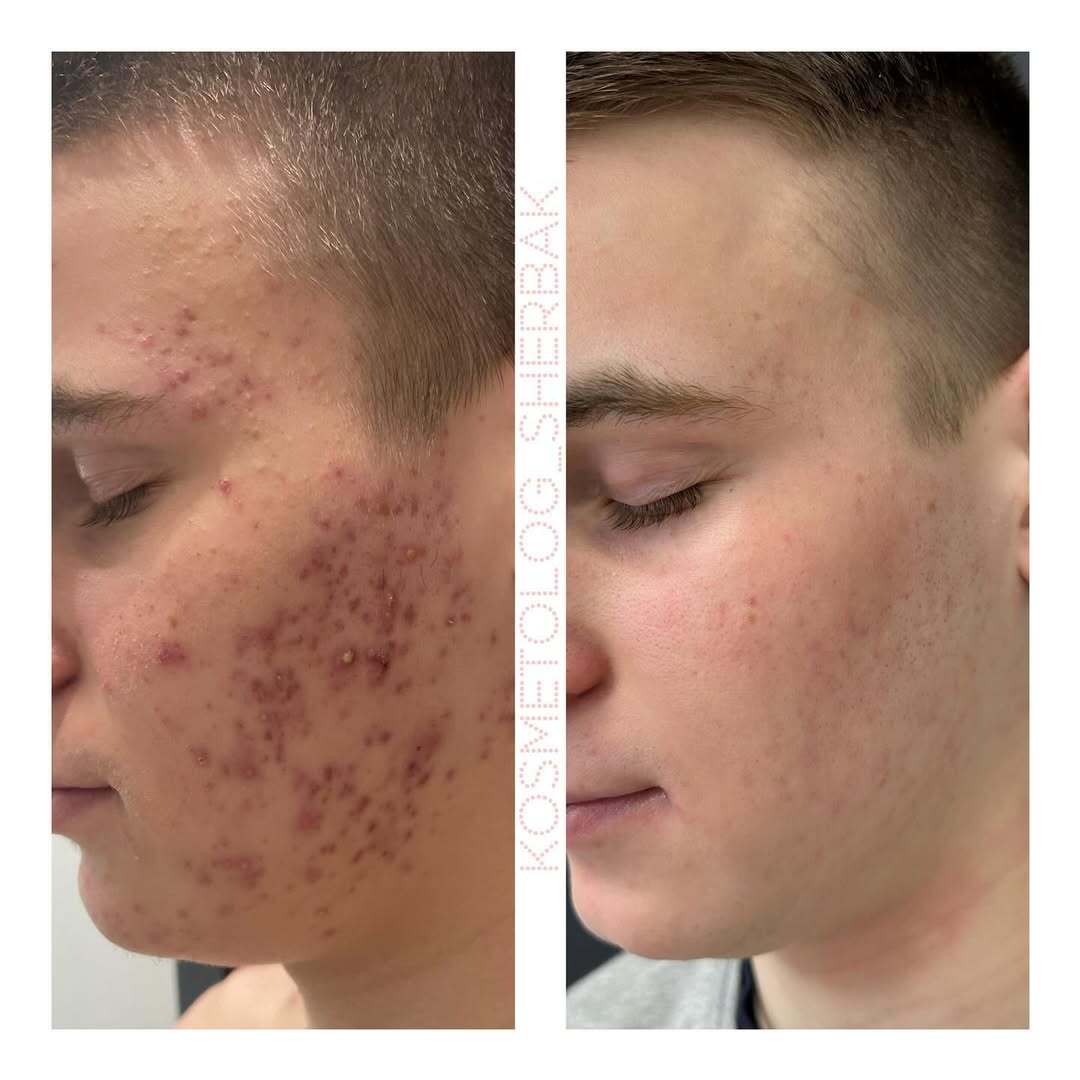 Лечение акне у женщины в клинике PradusCOSMO, СПб. До и после процедуры