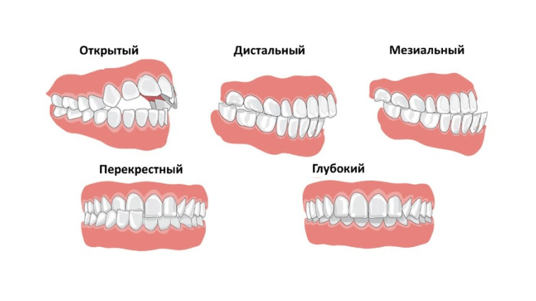 Вид неправильный. Дистальный прикус у детей. Правильный прикус зубов у человека. Неправильный прикус мезиальный.