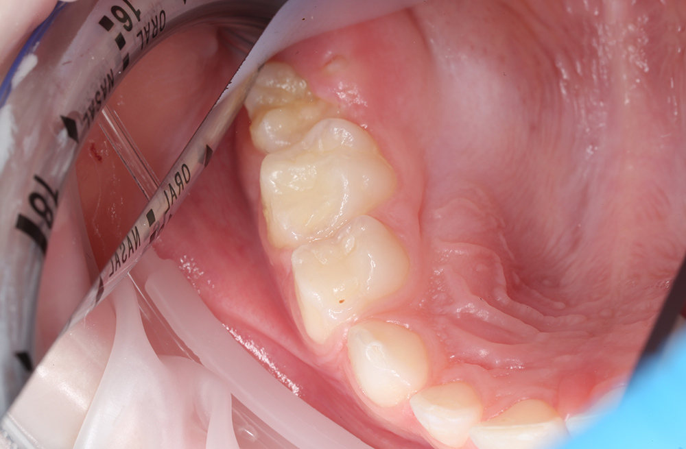 Лечение и восстановление зубов во сне за один визит ребенку 6 лет