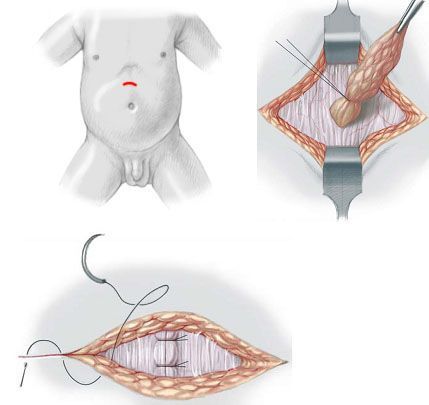 Послеоперационные фото грыжи белой линии живота Грыжа живота: лечение, виды, симптомы грыж передней брюшной стенки
