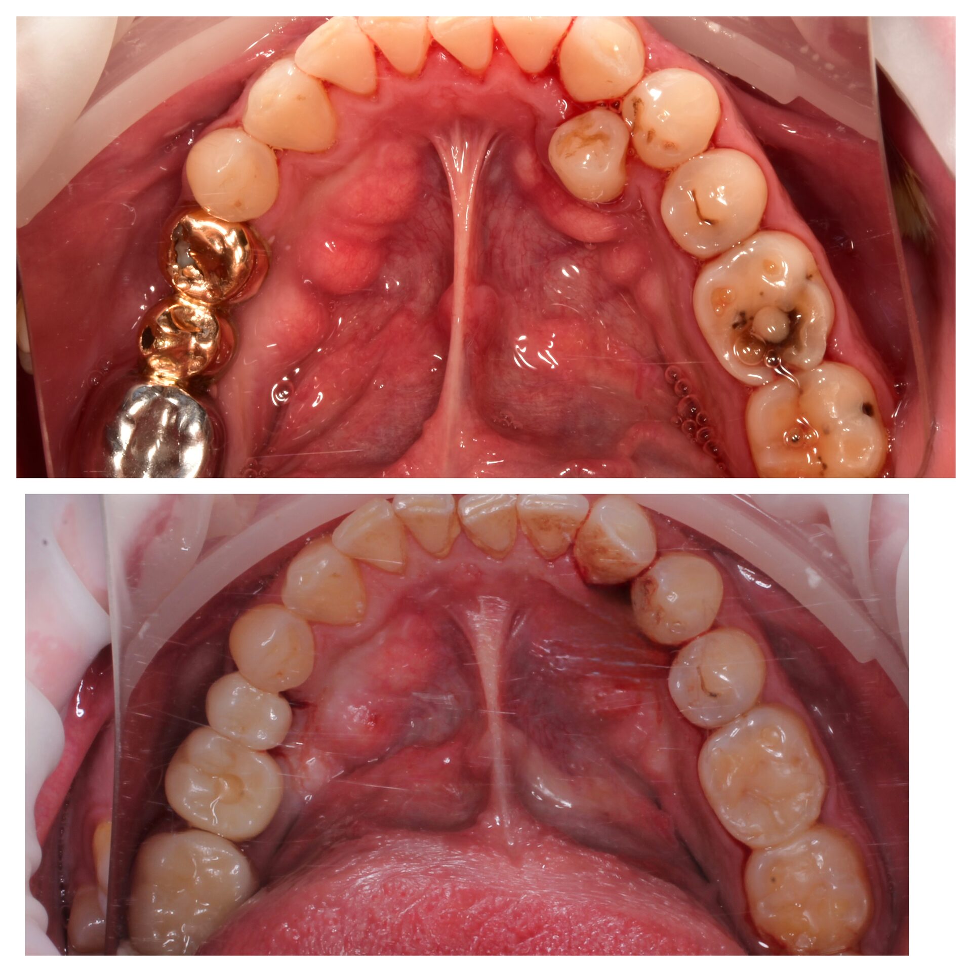 имплантация зубов чебоксары,имплантация зубов йошкар-ола,тотальная реабилитация на 6 имплантатах,протез несъемный в чебоксарах