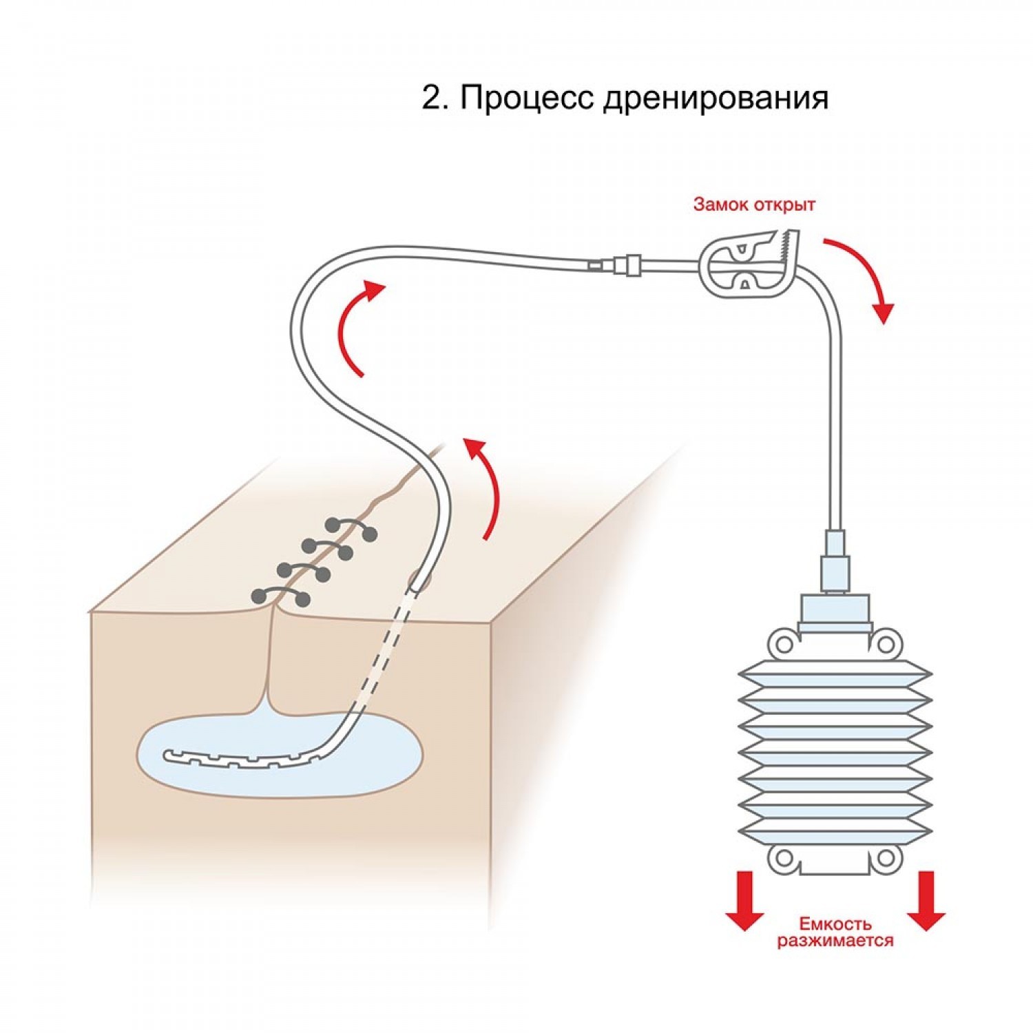Дренаж ран. Набор для дренирования РАН С катетером типа Редон. Вакуумный дренаж по Редону. Дренаж гармошка по Редону. Трубчатый сифонный дренаж.