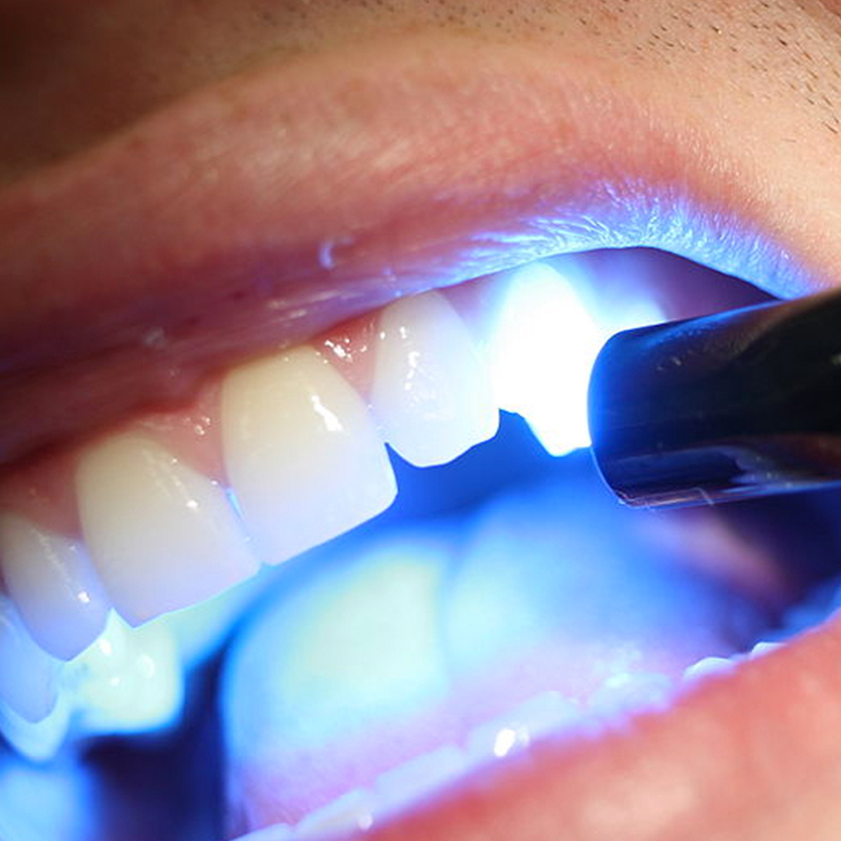 Лечение зубов в стоматологии Здоровая улыбка Щербинка