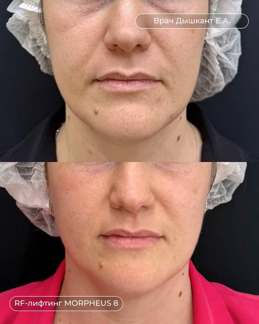RF-лифтинг - До и После