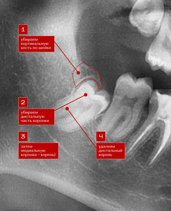этапы как проходит операция сложного удаления зуба мудрости