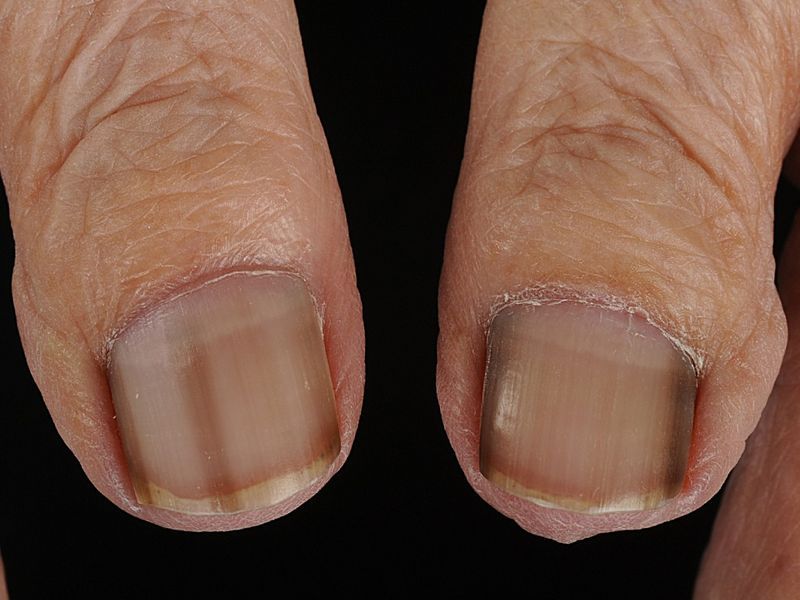 Синдром ногтя-надколенника - Педиатрия - Справочник MSD Профессиональная версия
