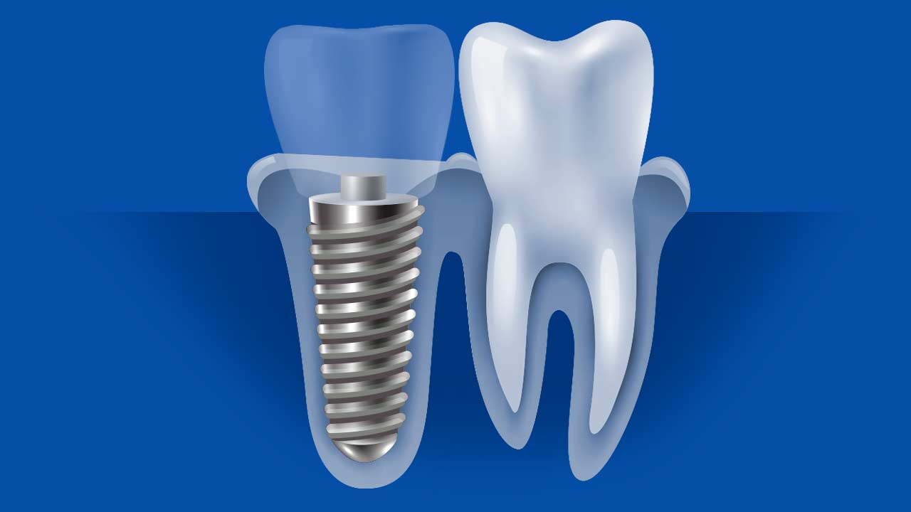 Имплант зуба картинка