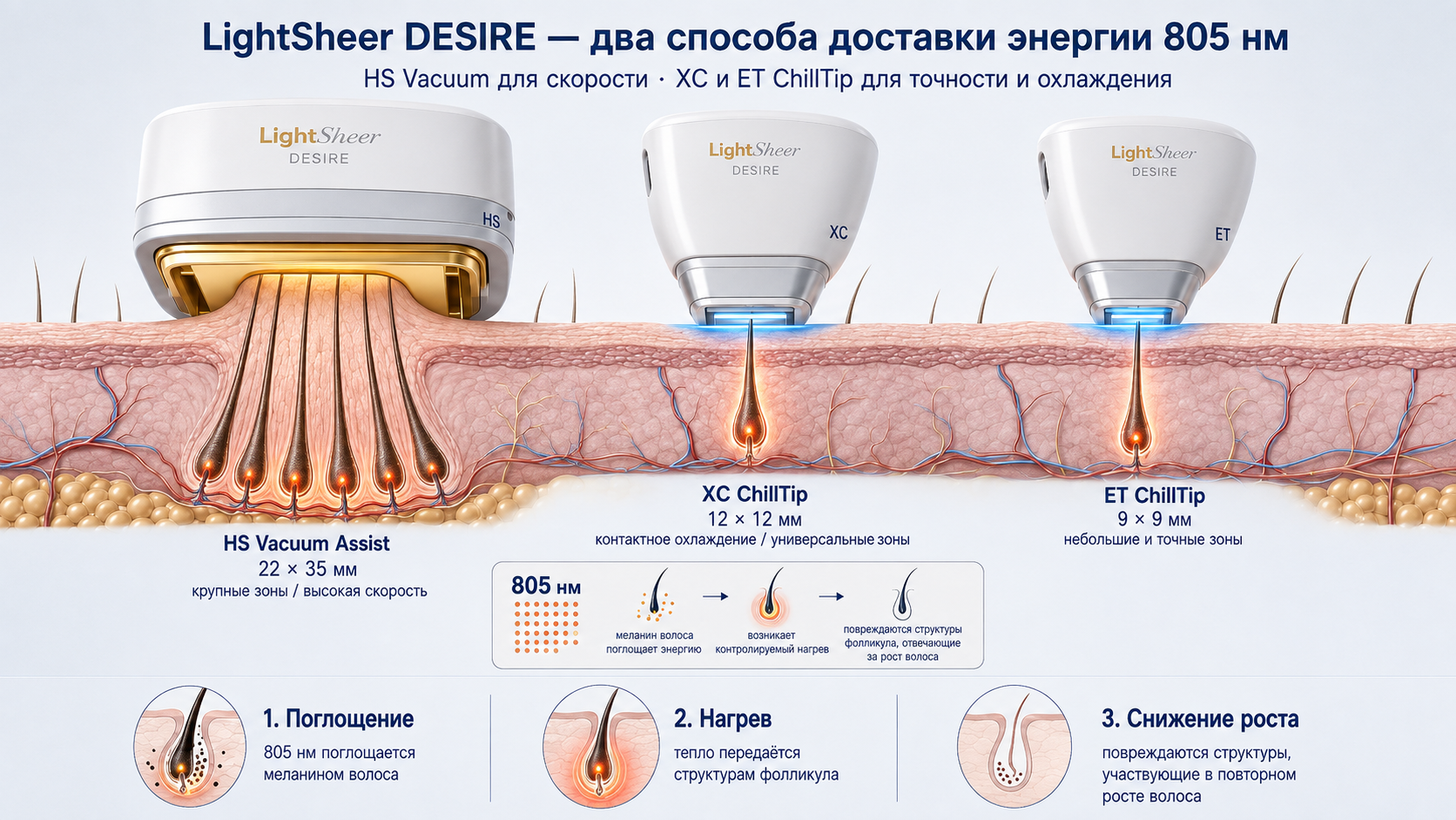 LightSheer DESIRE: HS Vacuum Assist, XC и ET ChillTip, воздействие 805 нм на волосяной фолликул