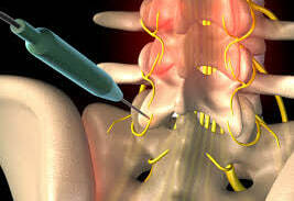 Радиочастотная абляция позвоночника (РЧА) - лечение боли в спине