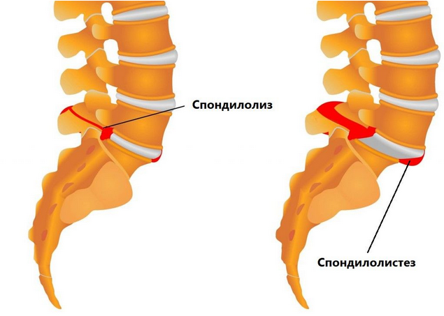 Спондилолиз и его осложнение — спондилолистез