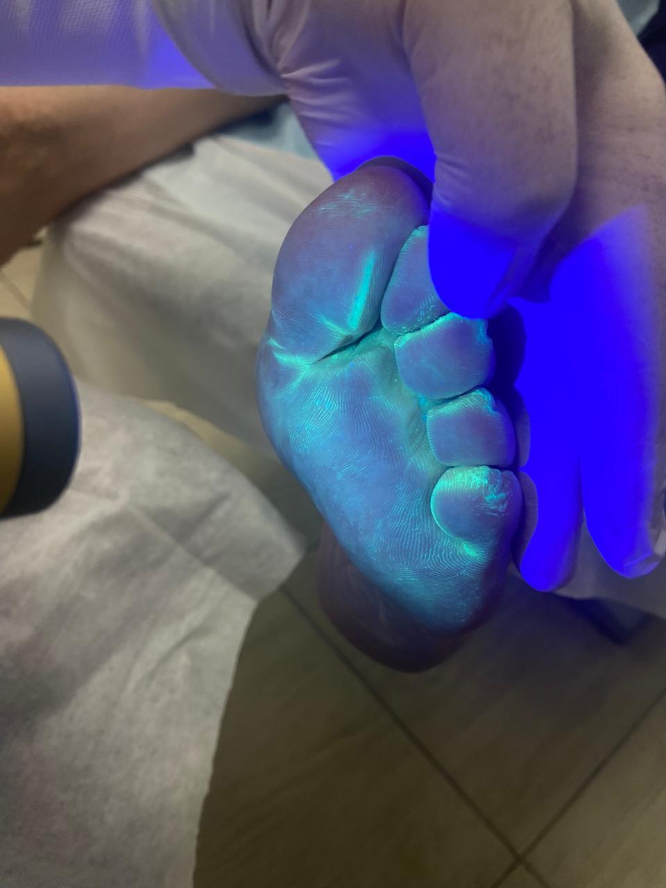 Диагностика лампой Вуда грибка стопы