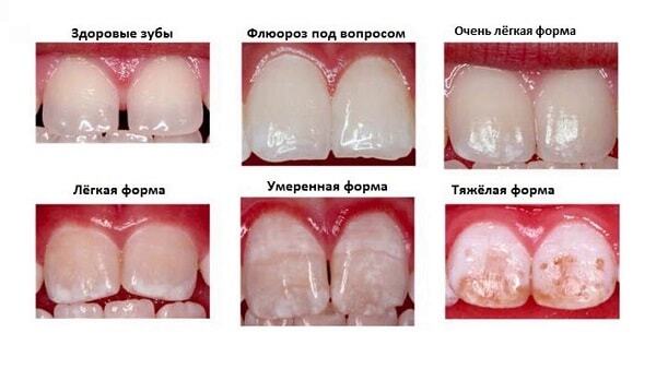Поражение зубов из-за избытка фтора в воде и пище: симптомы, лечение,  профилактика | Зубная Фея