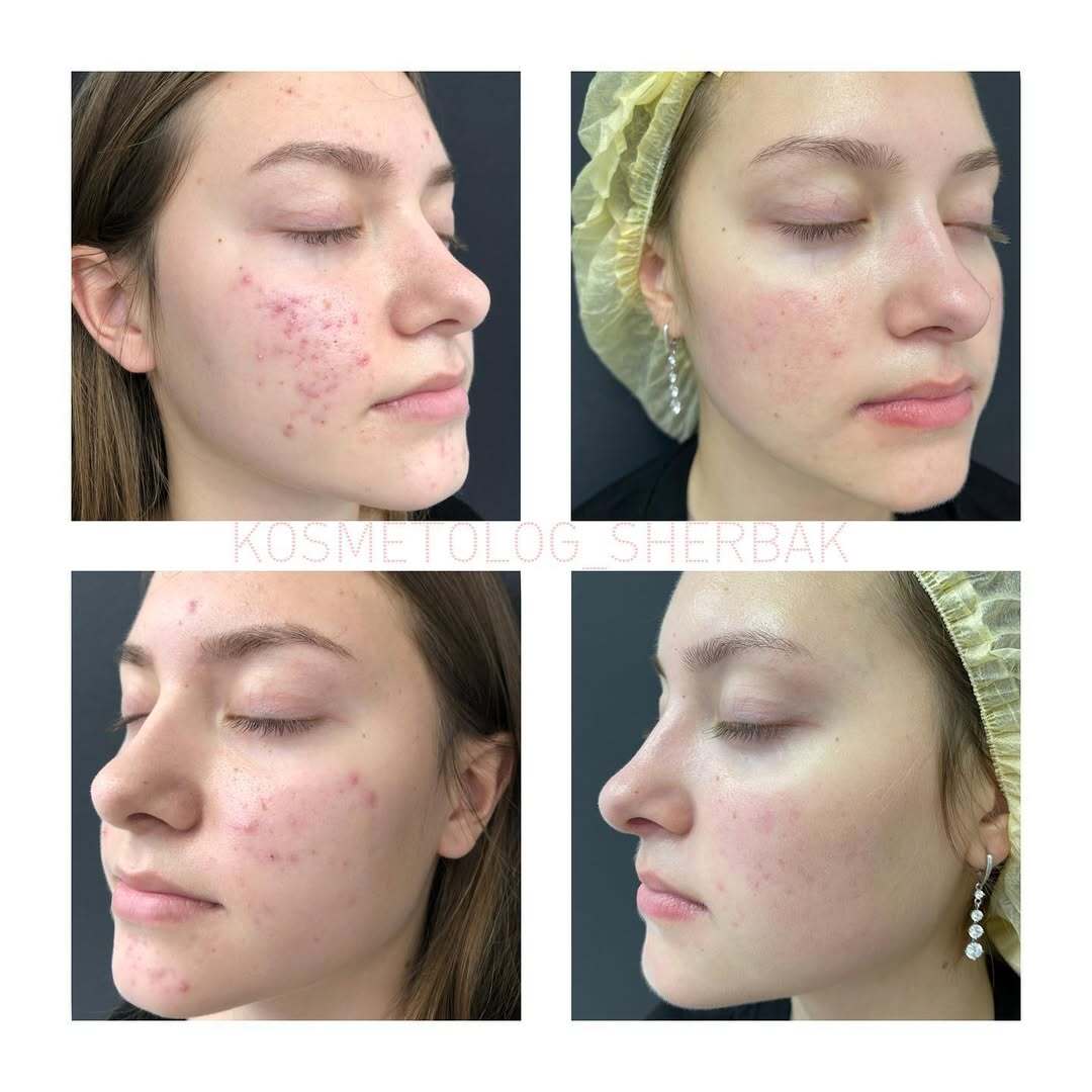Лечение акне у женщины в клинике PradusCOSMO, СПб. До и после процедуры