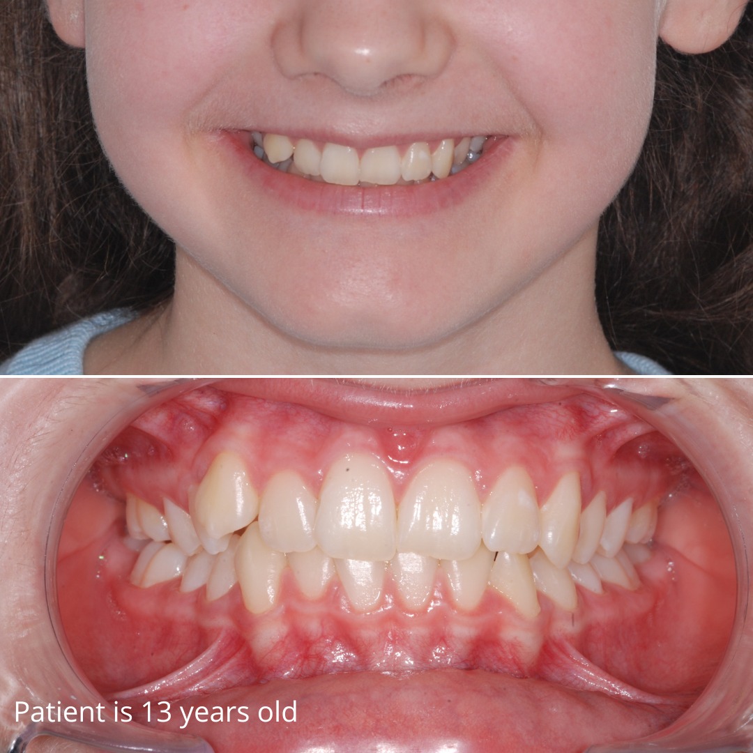 Mid-treatment view showing progressive alignment and repositioning of tooth 1.3 — photo 4 of 6