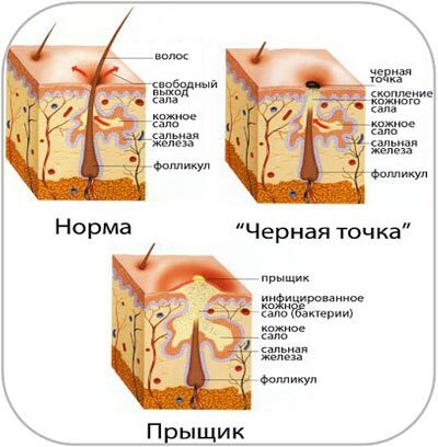 Гиперплазия сальных желез - клиника доктора Бреннера